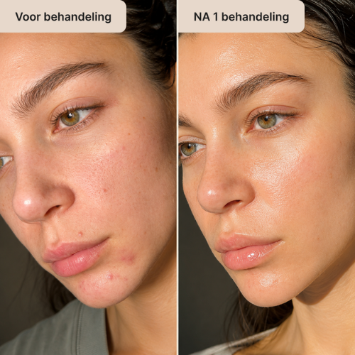 Liraza InfusePro – 24K Goud Micro-Infusie Systeem.